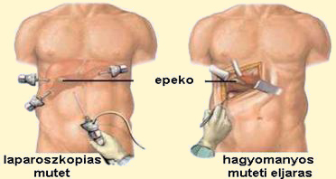 laparoszkópos veseműtét Relief gyertyák prosztatitis