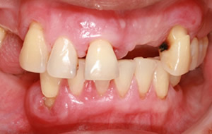fogmeder gyulladás tünetei