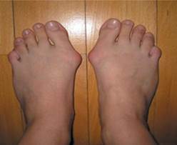 hogyan lehet enyhíteni a lábujj ízületgyulladását