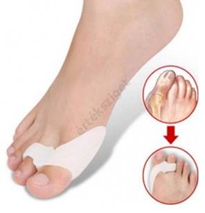 Bütyök (hallux valgus)