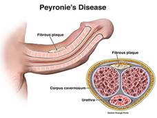 Peyronie-kór (A pénisz görbülete) tünetei és kezelése
