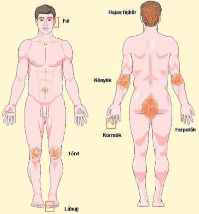 pikkelysömör egészségügyi gyógykezelés