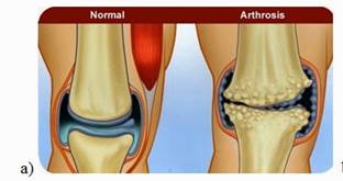 artrózis artritisz 1 fokos kezelés