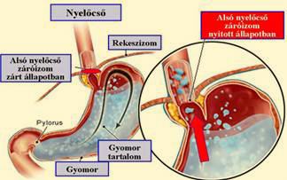 A gastrooesophagealis reflux betegség