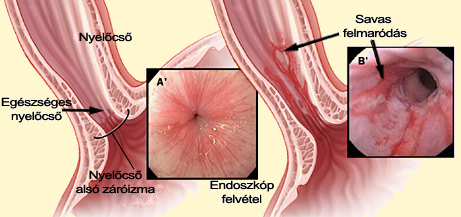 A gastrooesophagealis reflux betegség