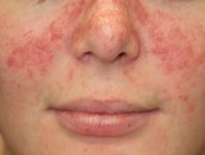 Pikkelysömör vagy seborrhoeás dermatitisz? Másképp kell kezelni
