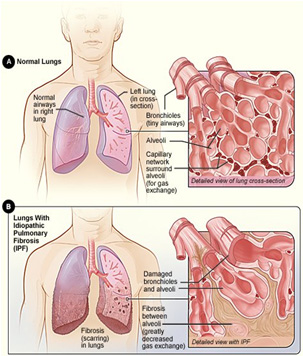 Tüdőfibrózis túlélése